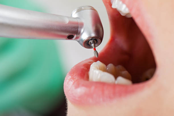 Best Emergency Root Canal Treatment in West Whittier Los Nietos, CA
